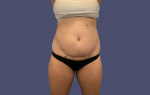 Abdominoplasty (Tummy Tuck) 18 Before